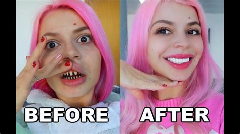 veneers in turkey reddit|Getting Veneers in Turkey! (Where I’ve Been) : r/JuliaZelg .